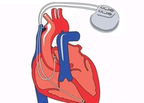 心脏起搏器是做什么的