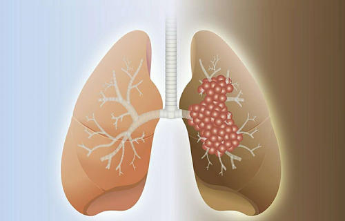 肺癌是什么原因引起的