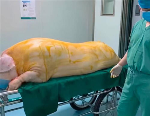 烧伤病人移植猪皮是什么原理